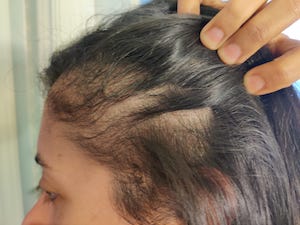 Where Did My Hair Go – A Story of Post Partum Hairloss | New Parents,Hair ,Motherhood,Post Partum Issues,#Useful | Blog Post by Zarine Bharda |  Momspresso